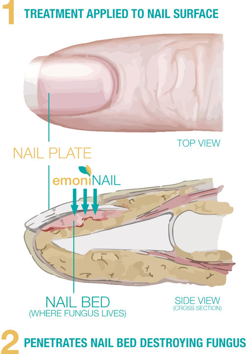 EmoniNail™ - Nail Fungus Treatment