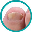 EmoniNail™ - Nail Fungus Treatment